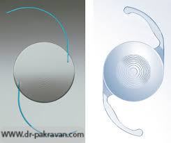 لنزهای مصنوعی چند کانونی (راست) در مقابل لنزهای تک کانونی (چپ)